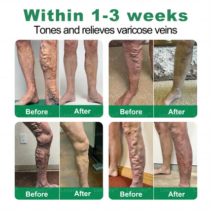 👨‍⚕️✅✅𝐋𝐞𝐱𝐚𝐬𝐤𝐲® 𝐕𝐞𝐢𝐧 𝐓𝐚𝐫𝐠𝐞𝐭 𝐌𝐢𝐜𝐫𝐨𝐧𝐞𝐞𝐝𝐥𝐞 𝐏𝐚𝐭𝐜𝐡⚡Instant Relief, Long-Term Results big sale